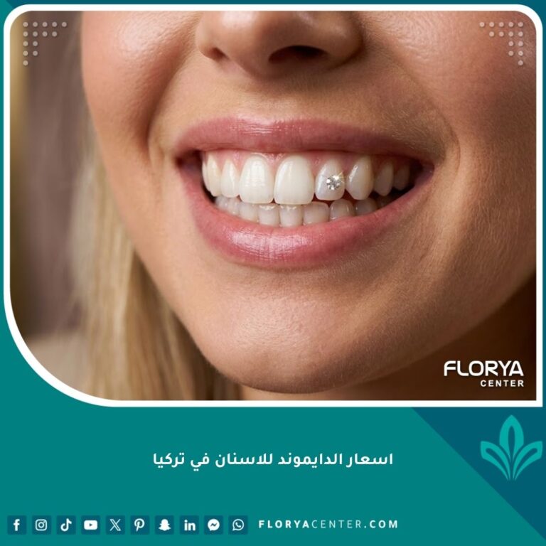 صورة بارزة تظهر ابتسامة ناصعة البياض مزينة بفص دايموند لامع يوضح التجميل البحت للأسنان في تركيا.