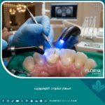 اسعار حشوات الكومبوزيت التجميلية للأسنان الأمامية في مركز أسنان متخصص