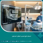 تكلفة واسعار خلع ضرس العقل المدفون في مركز أسنان متطور