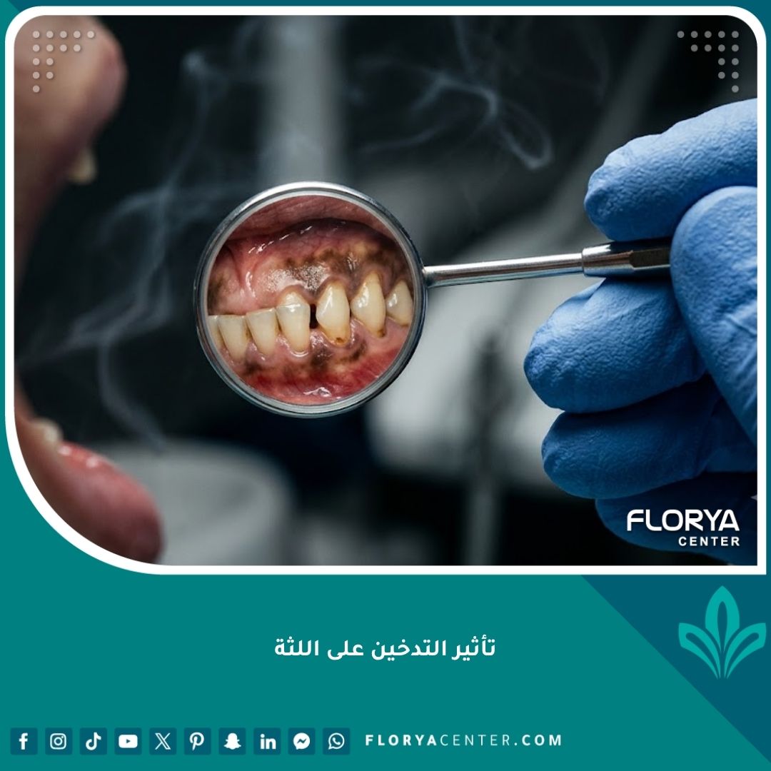 صورة مقربة تعكس تأثير التدخين على اللثة وتصبغها باللون الداكن باستخدام مرآة أسنان طبية.