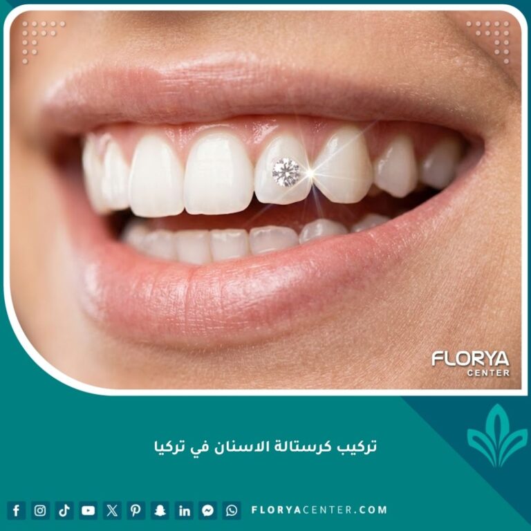 صورة مقربة لابتسامة مثالية تبرز جمال تركيب كرستالة الاسنان بلمسة تجميلية لامعة وجذابة.