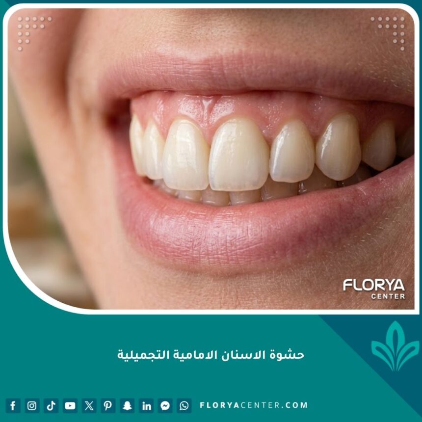 صورة مقربة تظهر جمال وشفافية حشوة الاسنان الامامية التجميلية وتطابقها التام مع لون السن الطبيعي.
