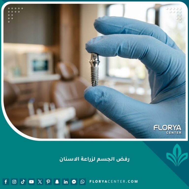 صورة مقربة لزرعة أسنان من التيتانيوم النقي يحملها طبيب أسنان، تمثل الجودة العالية لتجنب رفض الجسم لزراعة الاسنان.