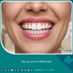ابتسامة صحية وناصعة البياض بعد علاج تشققات الأسنان في تركيا للحصول على مينا خالية من العيوب.
