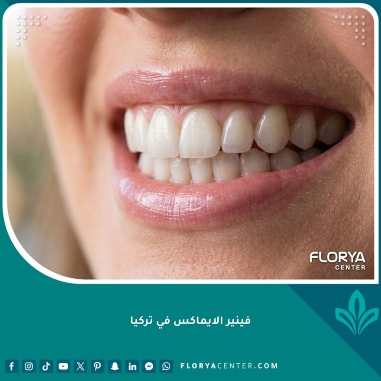 صورة مقربة لابتسامة جذابة تبرز جمال وشفافية فينير الايماكس الذي يطابق الأسنان الطبيعية تماماً.