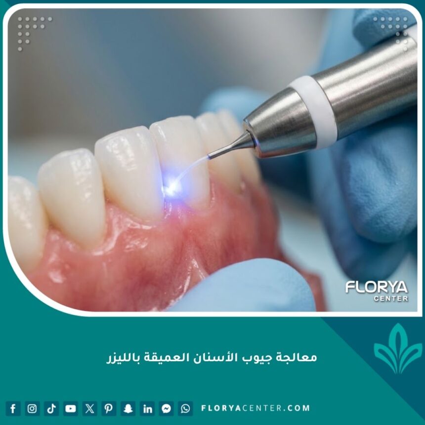 صورة مقربة توضح أحدث طرق معالجة جيوب الأسنان العميقة بالليزر بدون جراحة أو ألم.