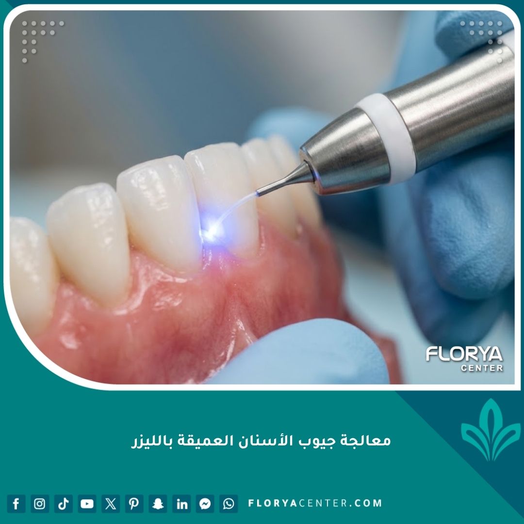 صورة مقربة توضح أحدث طرق معالجة جيوب الأسنان العميقة بالليزر بدون جراحة أو ألم.