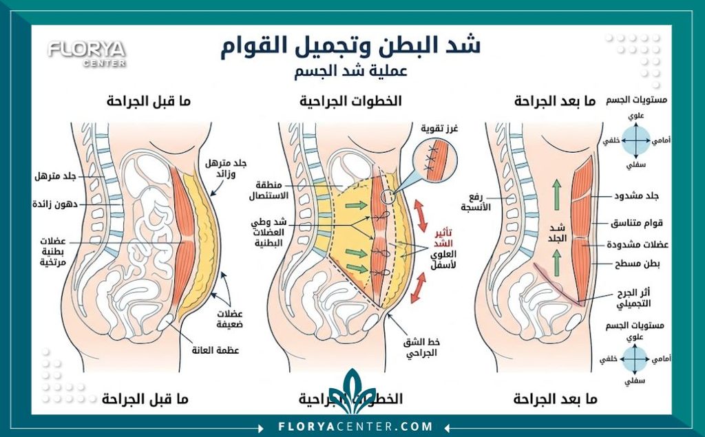 أرخص دولة لإجراء عمليات شد الترهلات 2 رسم توضيحي طبي لكيفية إجراء عملية شد الترهلات وتنسيق القوام