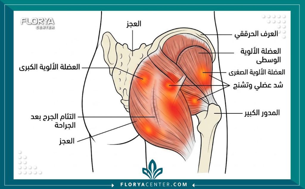 رسم توضيحي طبي يوضح تشريح العضلات وأسباب الشعور بالشد العضلي بعد عملية تكبير الأرداف.