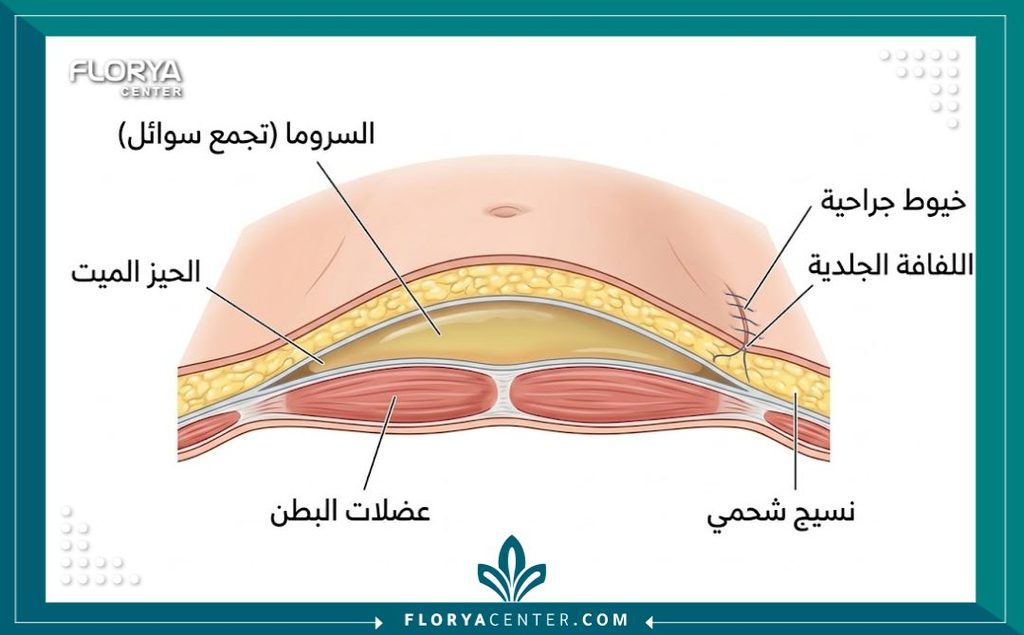 رسم طبي يوضح مكان تجمع السوائل تحت الجلد بعد شد البطن والانتفاخ المفاجئ.