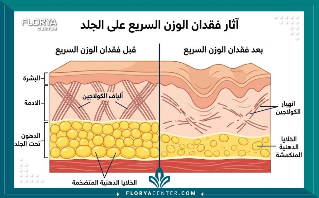 رسم توضيحي طبي لطبقات الجلد يوضح تأثير النزول السريع للوزن بإبر المنجارو على ترهل الجلد ونقص الكولاجين.