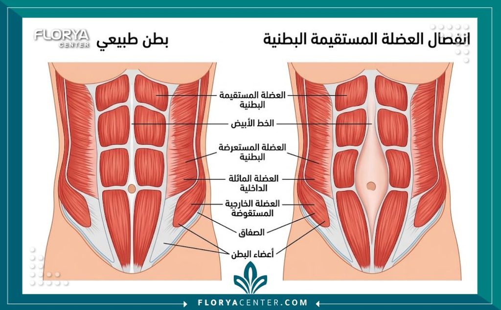 رسم توضيحي طبي دقيق يشرح التشريح العضلي للبطن والفرق بين العضلات السليمة وحالة الانفصال العضلي.