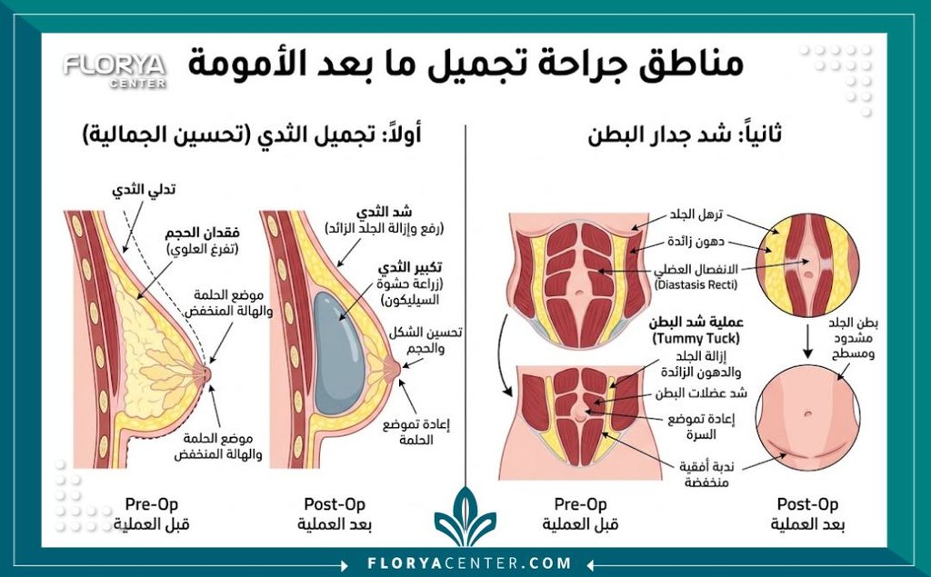 أفضل دكتور لعمليات تجميل ما بعد الأمومة 2 رسم تخطيطي طبي يوضح المناطق المستهدفة في عملية تجميل ما بعد الأمومة