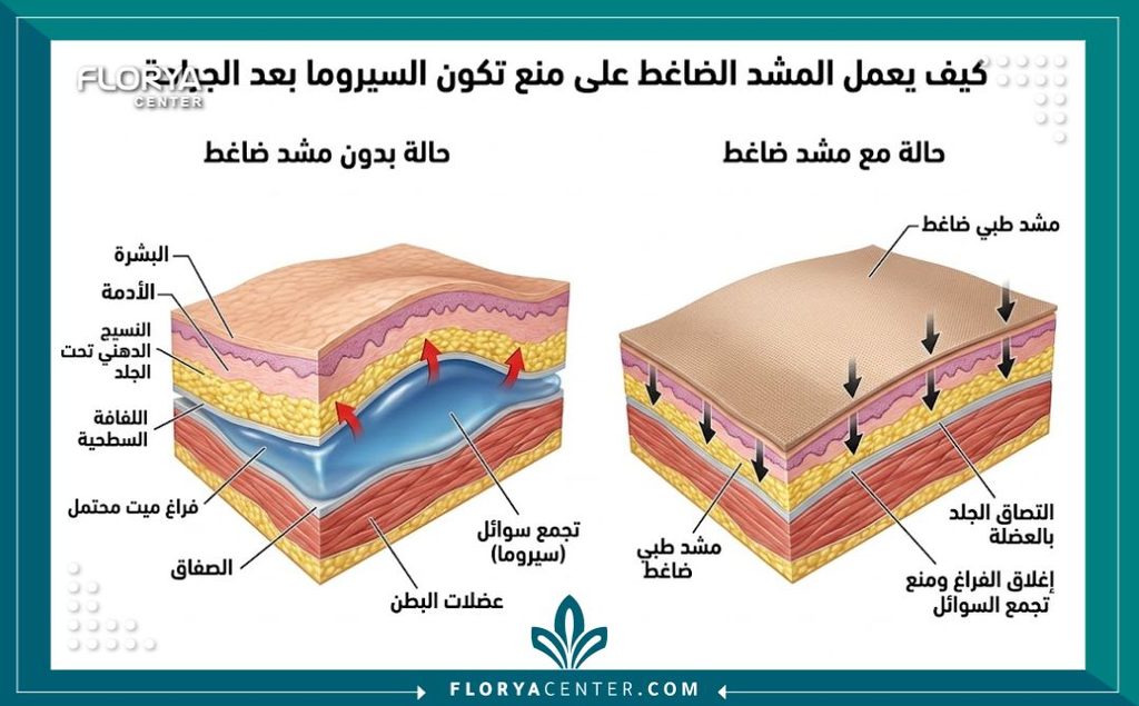 أهمية ارتداء المشد الطبي بعد عمليات النحت 2 رسم توضيحي طبي يوضح كيف يساعد المشد الطبي في التصاق الجلد بالعضلات ومنع تراكم السوائل بعد عملية النحت.