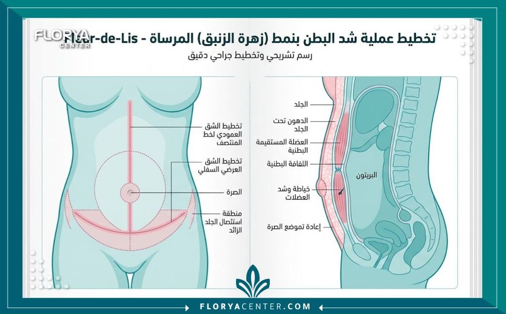 رسم توضيحي طبي يوضح أماكن الشق الجراحي الطولي والعرضي في عملية شد البطن المقلوب.