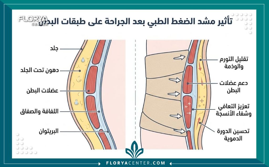 أين تباع مشدات ما بعد عمليات التجميل 2 رسم توضيحي طبي يوضح فوائد ارتداء المشدات الطبية بعد عمليات التجميل لتقليل التورم.