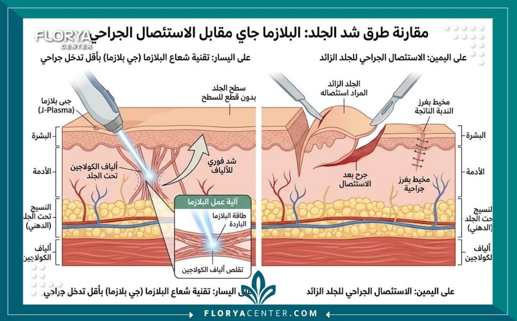 رسم توضيحي طبي يشرح آلية عمل الجي بلازما لشد الجلد من الداخل مقارنة بإزالة الجلد جراحياً.