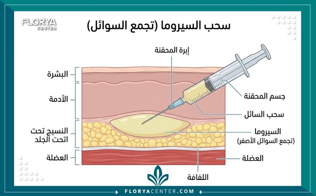 إدارة السيروما طبياً بالبزل المستمر (Seroma Aspiration) 2 رسم توضيحي طبي لطبقات الجلد يوضح تجمع السوائل وطريقة إدارة السيروما طبياً بالبزل.