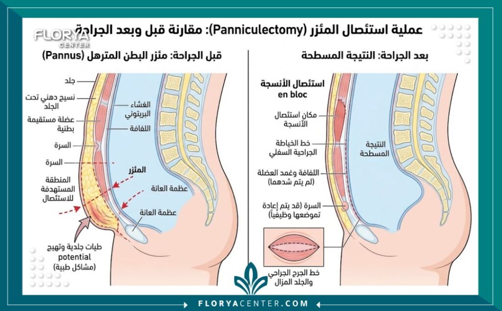 رسم توضيحي طبي يوضح تشريح البطن ومراحل عملية استئصال السبلة الشحمية وقص الجلد المتدلي.