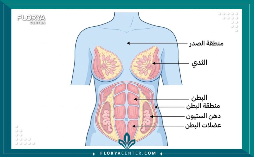 رسم طبي توضيحي يبين المناطق المستهدفة في عملية المامي ميك أوفر مثل شد البطن ورفع الصدر.