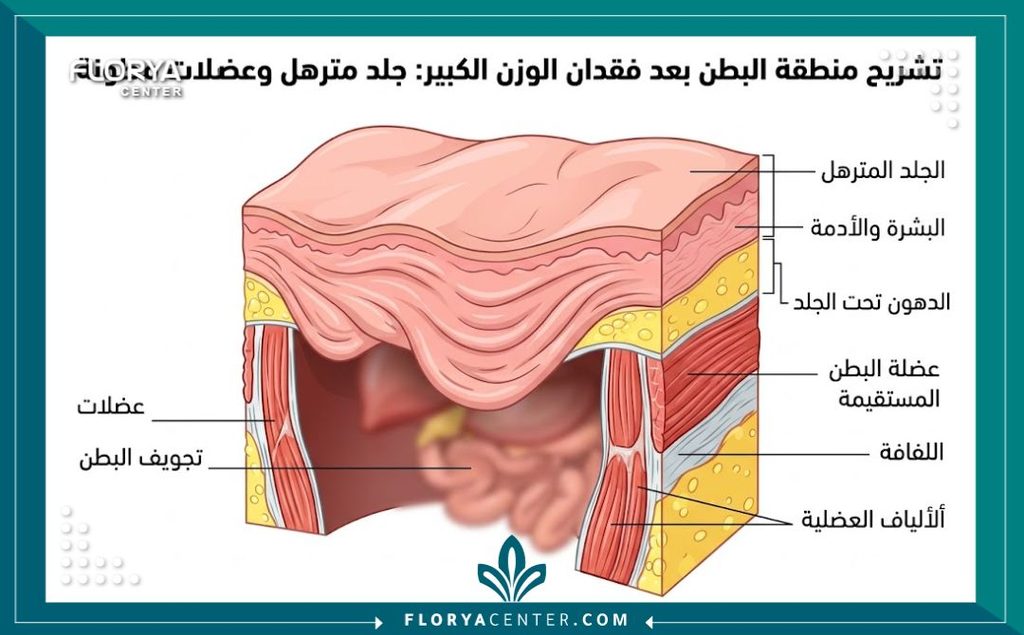 الاستعدادات الطبية قبل عملية شد الجسم بعد التكميم 2 رسم توضيحي طبي لطبقات الجلد والعضلات يوضح ترهلات الجلد التي يتم علاجها خلال عملية شد الجسم بعد التكميم.