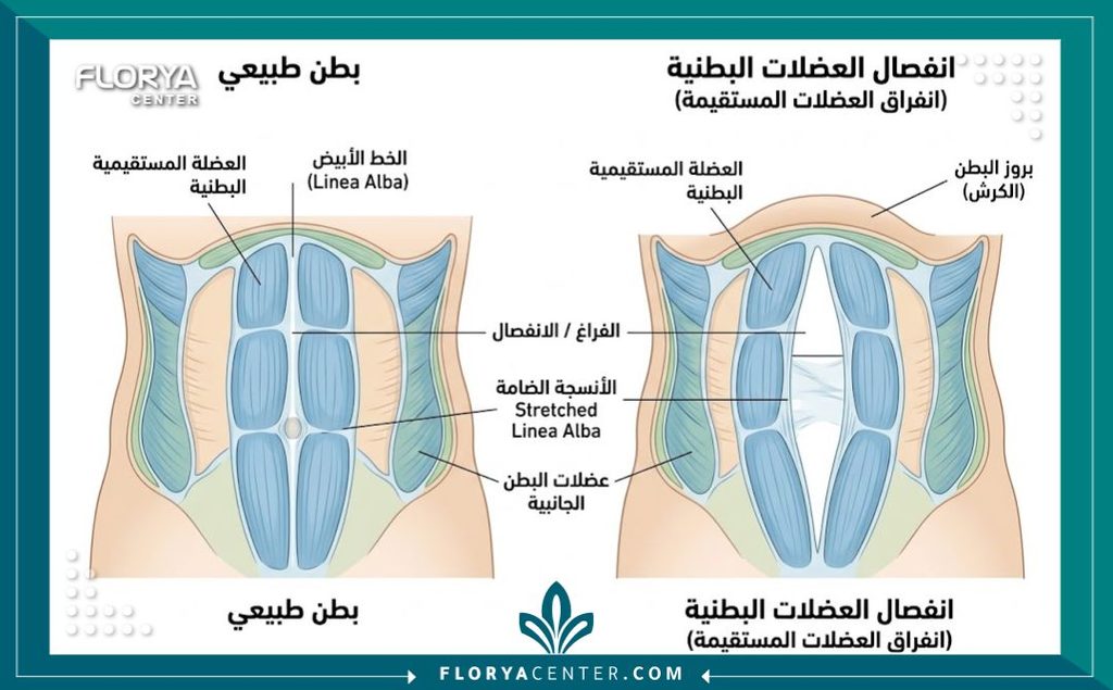 الانفصال العضلي 2 رسم توضيحي طبي يشرح تشريح تباعد عضلات البطن والفرق بين العضلات السليمة وحالة الانفصال العضلي.