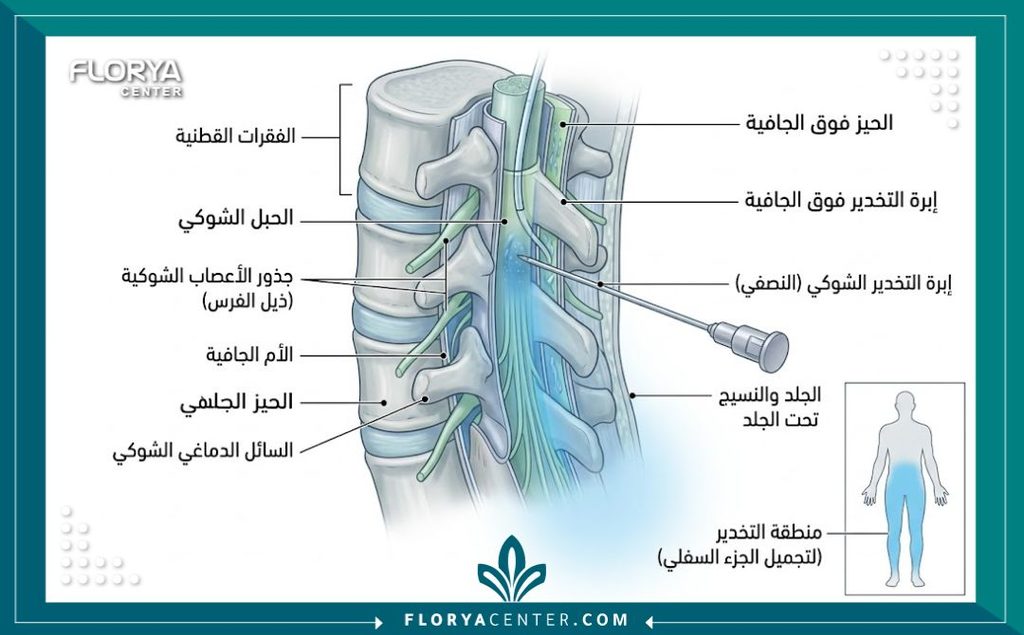 التخدير الناحي (Regional Anesthesia) في جراحات التجميل 2 رسم توضيحي طبي يبين طريقة حقن التخدير النصفي أو إبرة الظهر لتخدير الجزء السفلي من الجسم في عمليات التجميل.