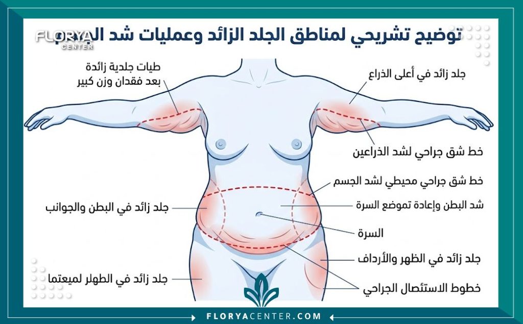 رسم توضيحي طبي يحدد مناطق تجمع ترهلات الجسم وخطوات جراحة التخلص من ثنيات الجلد المتدلية.
