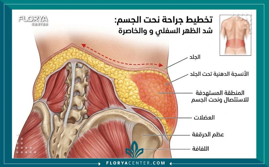 التخلص من جيوب الجلد في أسفل الظهر 2 رسم توضيحي طبي لتشريح أسفل الظهر يوضح أماكن تراكم جيوب الجلد والكتل المتدلية فوق المؤخرة.
