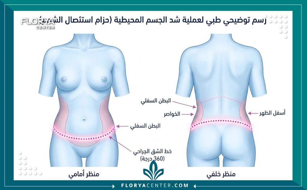 رسم توضيحي طبي ثلاثي الأبعاد يوضح مسار الشق الجراحي في عملية الشد الحزامي 360 درجة لقص الجلد المترهل.