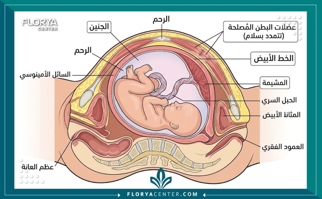 الحمل بعد عملية شد البطن 2 رسم توضيحي طبي مفصل يوضح كيف تتمدد عضلات البطن المشدودة بأمان أثناء فترة الحمل بعد عملية شد البطن.