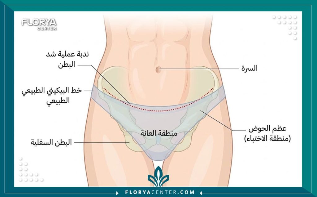 رسم توضيحي طبي دقيق يحدد مكان الشق الجراحي المخفي في خط البكيني لعملية شد البطن لضمان عدم ظهوره أسفل الملابس الداخلية.