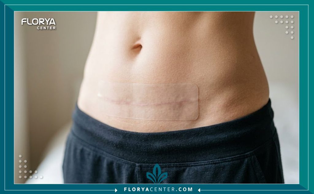 تطبيق لصقات السيليكون الشفافة على جرح عملية شد البطن لضمان التئام تجميلي ومنع بروز أو اسمرار الندبة.
