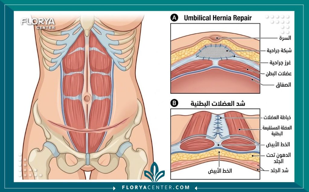 رسم توضيحي طبي مفصل يشرح كيفية إصلاح الفتق السري طبياً مع شد عضلات البطن تجميلياً.