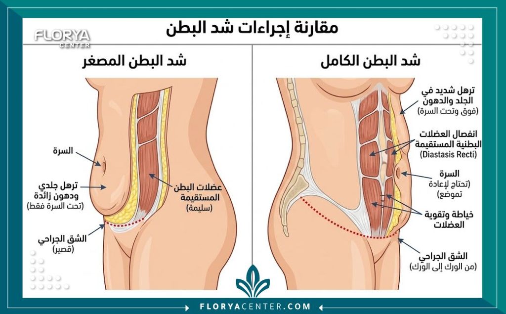 رسم توضيحي طبي يوضح تشريحياً الفرق بين شد البطن المصغر والكامل ودرجات الترهل وانفصال العضلات.