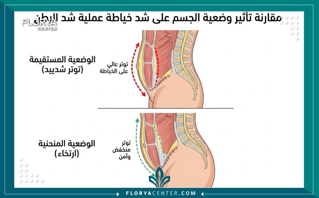 المشي بعد شد البطن 2 رسم توضيحي طبي يوضح الفرق بين الوقوف باستقامة والمشي بظهر منحنٍ لتجنب تمزق غرز شد البطن.