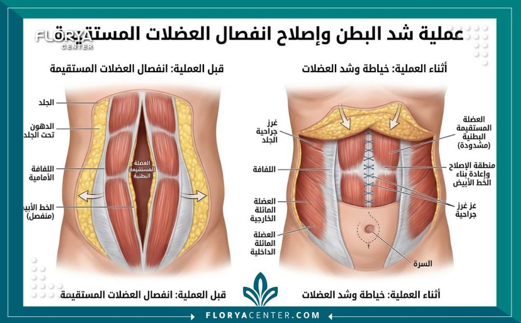 الم بعد عملية شد البطن 2 رسم توضيحي طبي يوضح عملية خياطة وشد عضلات البطن التي تعتبر المصدر الأساسي للألم بعد العملية.