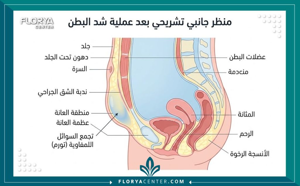 انتفاخ العانة بعد عملية شد البطن 2 رسم توضيحي طبي يوضح تشريح تجمع السوائل وحدوث تورم في منطقة العانة بعد جراحة شد البطن.