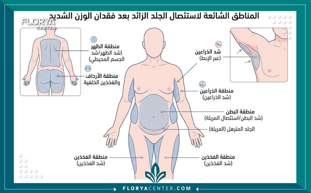 رسم توضيحي طبي يبين مناطق شد الجسم وعمليات قص الجلد الزائد بعد التكميم وفقدان الوزن.