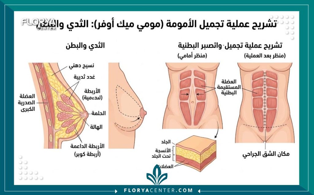 رسم توضيحي طبي يوضح تشريح مناطق البطن والثدي المستهدفة في عملية المامي ميك أوفر.