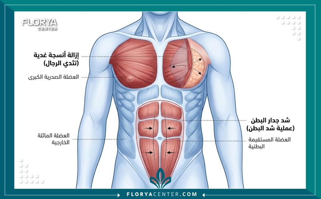 رسم توضيحي طبي لتشريح عضلات الصدر والبطن يوضح مناطق التدخل الجراحي لعلاج التثدي وشد البطن للرجال.