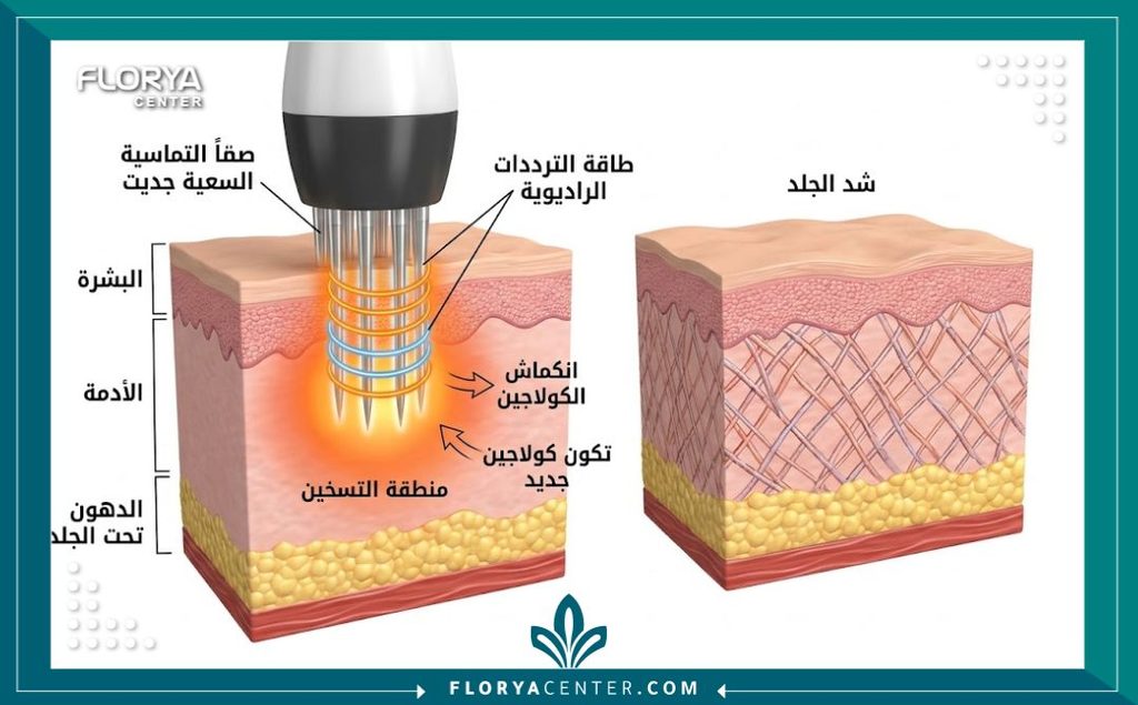 رسم توضيحي طبي لطبقات الجلد يوضح كيفية عمل الترددات الراديوية كأفضل بديل للجي بلازما لشد الترهلات.