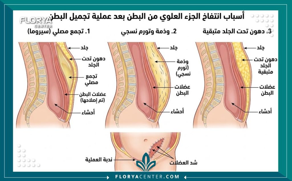 رسم توضيحي طبي يشرح أسباب بروز أعلى البطن بعد عملية شد البطن والفرق بين تجمع السوائل والدهون المتبقية.
