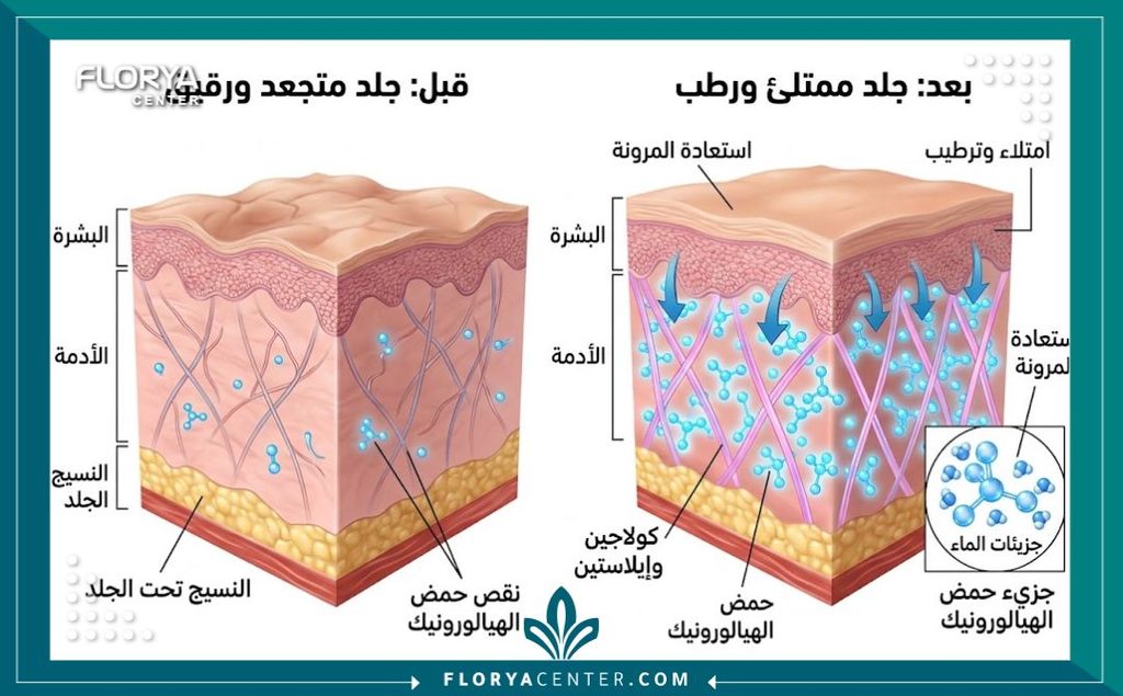 تأثير حقن البروفايلو على شد ترهلات الجسم 2 رسم توضيحي طبي لطبقات الجلد يوضح آلية عمل الإبرة المرطبة وتأثيرها على شد ترهلات الجسم وتحفيز الكولاجين والإيلاستين.