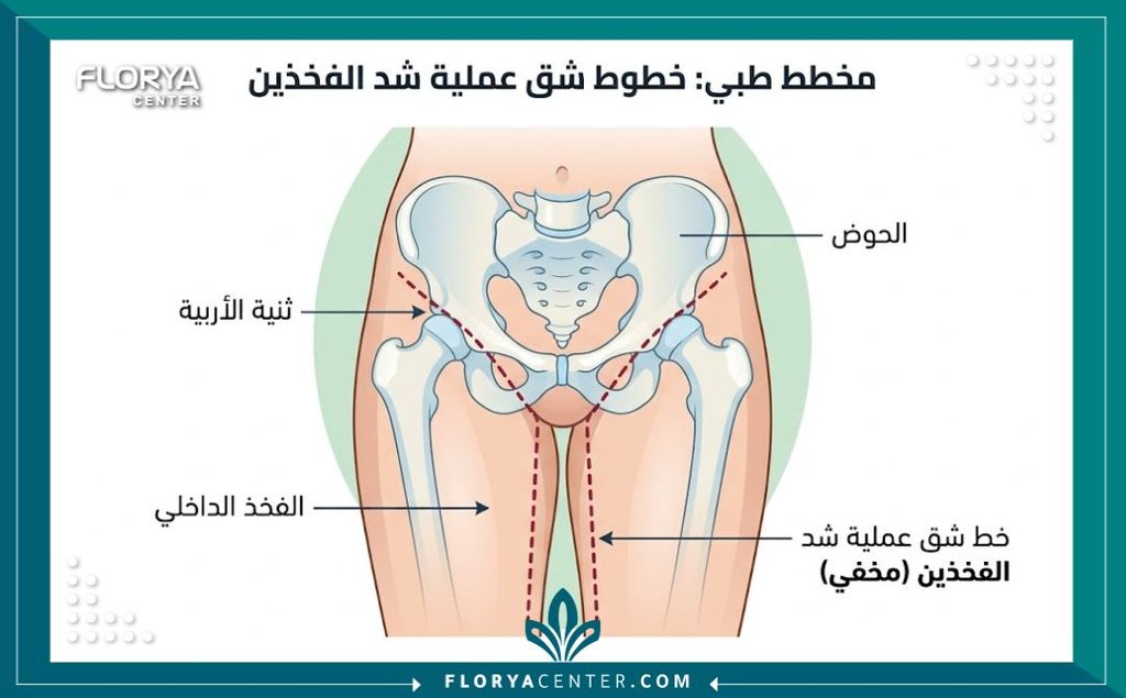 رسم توضيحي طبي يبين أماكن الشق الجراحي العرضي والطولي المخفية في عملية شد الأفخاذ.