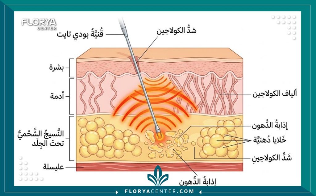 تجارب تقنية البودي تايت لشد الترهلات 2 رسم توضيحي طبي يشرح آلية عمل تقنية البودي تايت بالراديو فريكونسي لإذابة الدهون وشد الجلد.