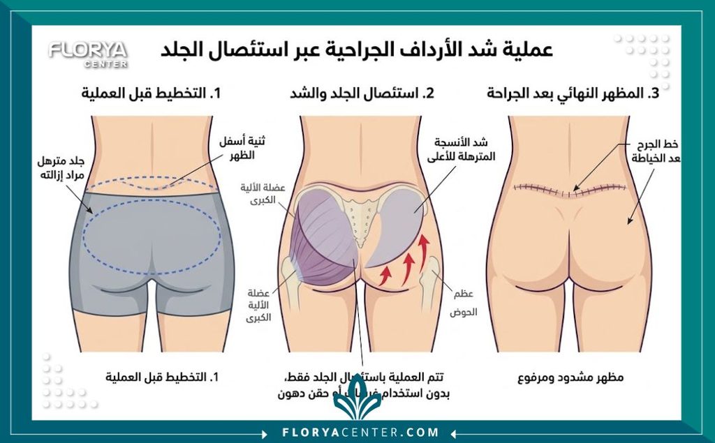 تجارب شد المؤخرة جراحياً بدون حشوات 2 رسم توضيحي طبي يشرح خطوات عملية شد المؤخرة جراحيا عن طريق قص الجلد المترهل ورفعه للأعلى بدون استخدام دهون أو حشوات.