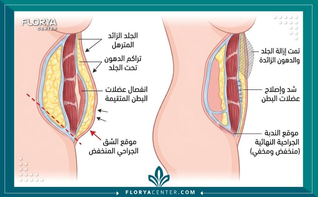 رسم توضيحي طبي يوضح خطوات جراحة شد البطن ومكان الندبة السفلية للمقارنة بين البطن المترهل وأثر الجراحة.