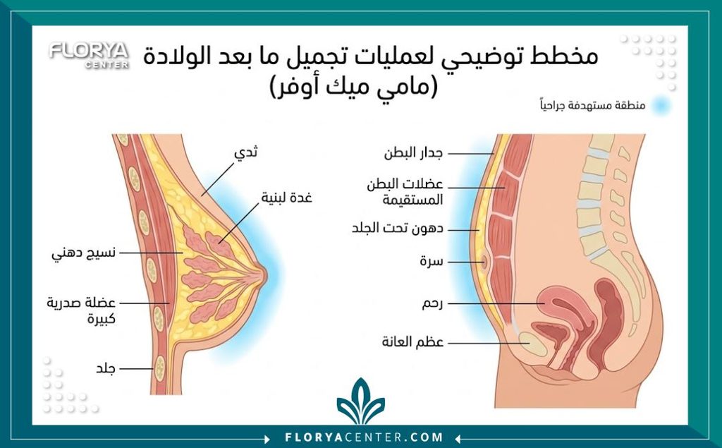 تجربتي مع المامي ميك اوفر 2 رسم توضيحي طبي يشرح مناطق الجسم التي تستهدفها عملية المامي ميك اوفر مثل شد البطن ورفع الصدر.