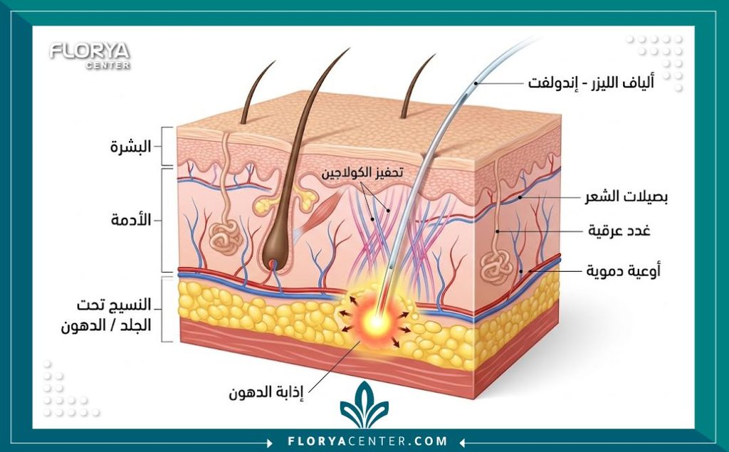 تجربتي مع جهاز الإندوليف لشد الترهلات 2 رسم طبي توضيحي لطبقات الجلد يوضح آلية عمل تقنية الإندوليف في تحفيز الكولاجين وشد الترهلات العميقة.